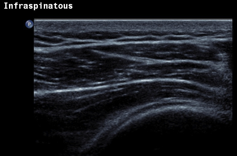 Shoulder Ultrasound Infraspinatous Normal